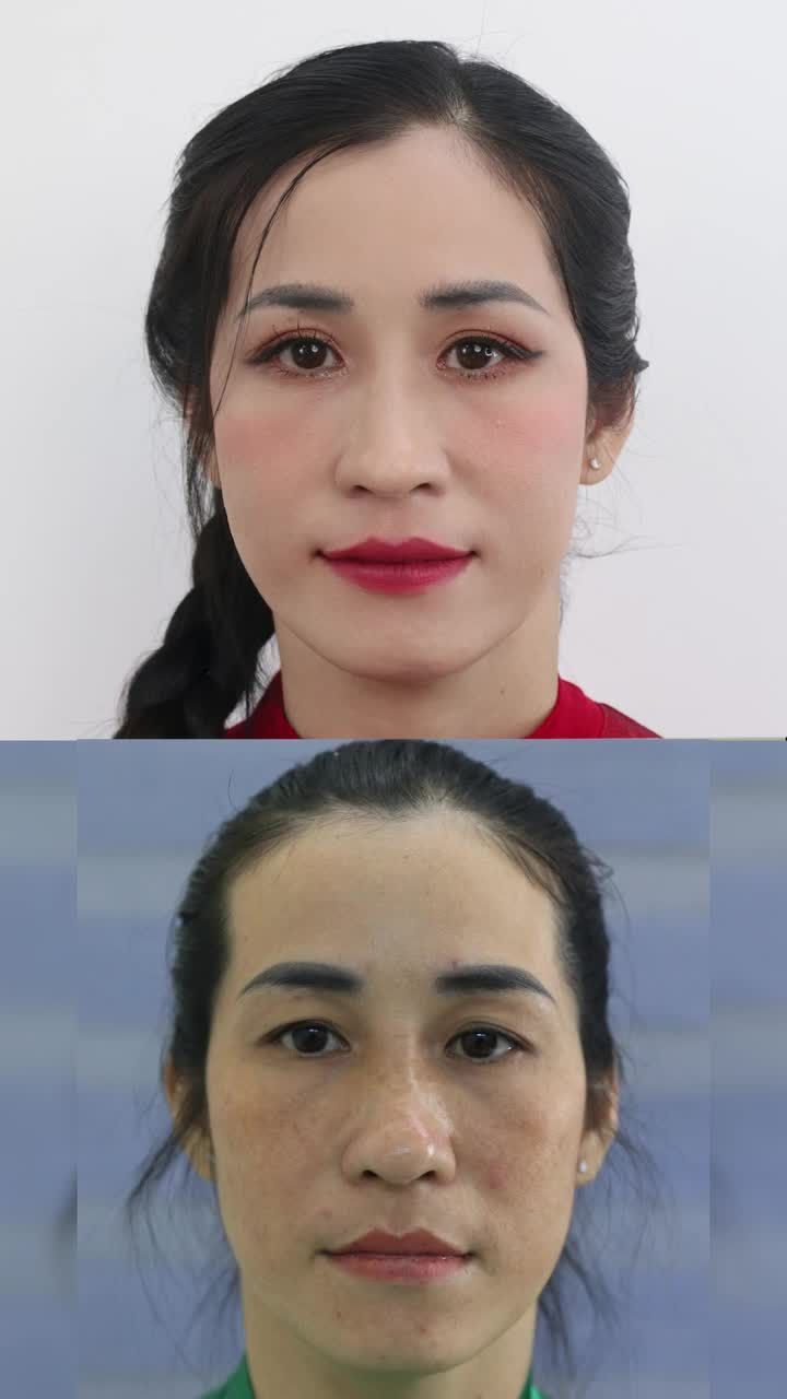 Sợ sưng, sợ lâu lành, sợ không kịp đón Tết?