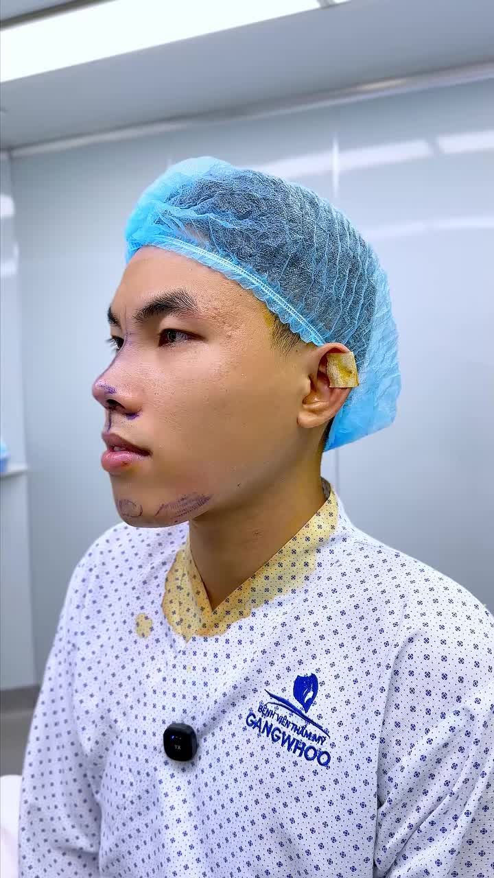 CẬN CẢNH DÁNG MŨI MỚI – "LỘT XÁC" ĐIỂN TRAI SAU 60 PHÚT PHẪU THUẬT