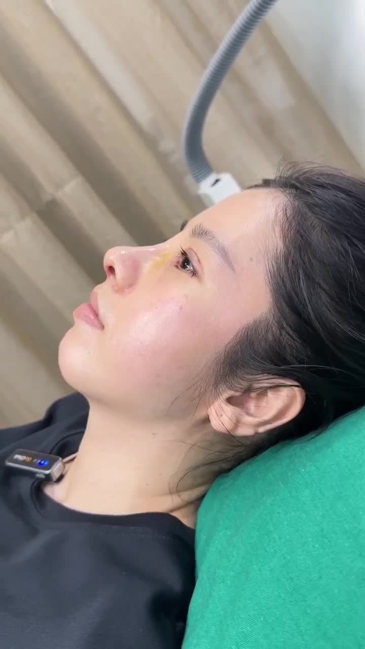 10 NGÀY NÂNG MŨI THAY ĐỔI CỠ NÀO XEM NGAY LIVESTREAM CÙNG SAIGON STAR KIỂM CHỨNG NHÉ!