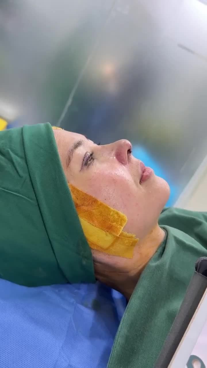 KẾT QUẢ NÂNG MŨI CẤU TRÚC DR. HOẠT + CẮT MÍ SỬA MÍ LỖI KH. HUANG YU CHIN (ĐÀI LOAN)