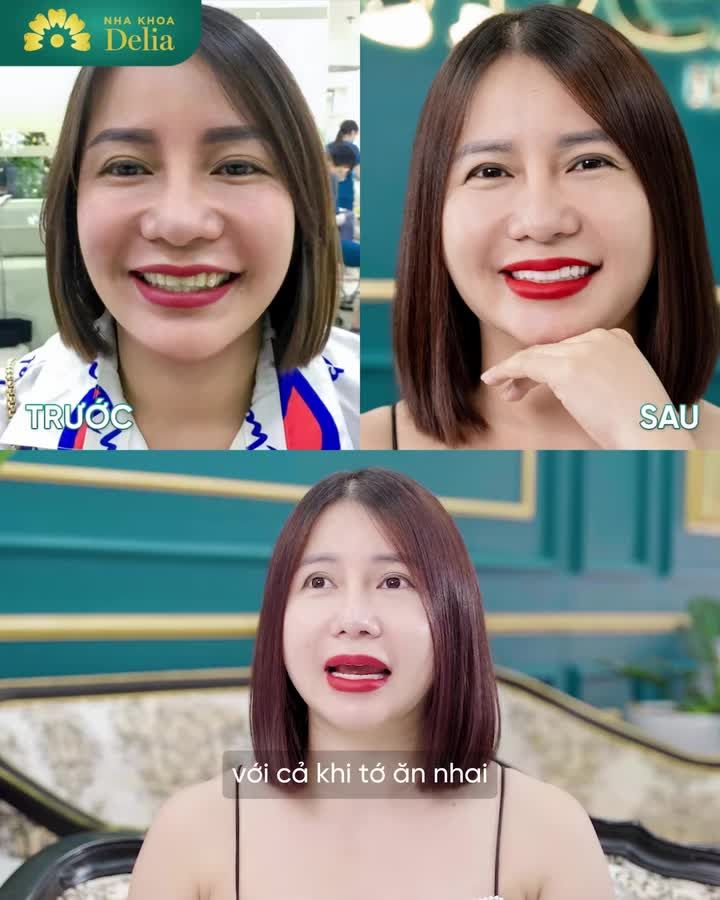 Chị gái Bắc Ninh từ ngày làm 20 răng sứ về buôn may bán đắt. Xem ngay!