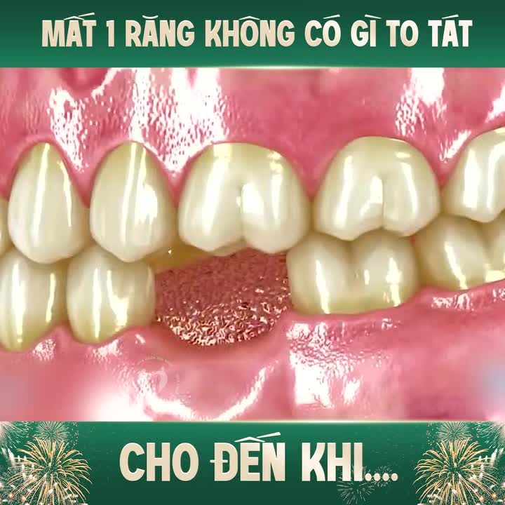 MẤT 1 RĂNG THÌ CÓ GÌ TO TÁT. CHO ĐẾN KHI....