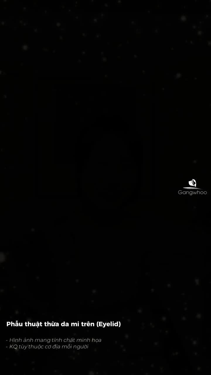 Sau 7 ngày cắt mí, đường khâu đã ổn định và hồi phục nhanh chóng. Giúp diện mạo tươi tắn, sẵn sàng đón xuân.