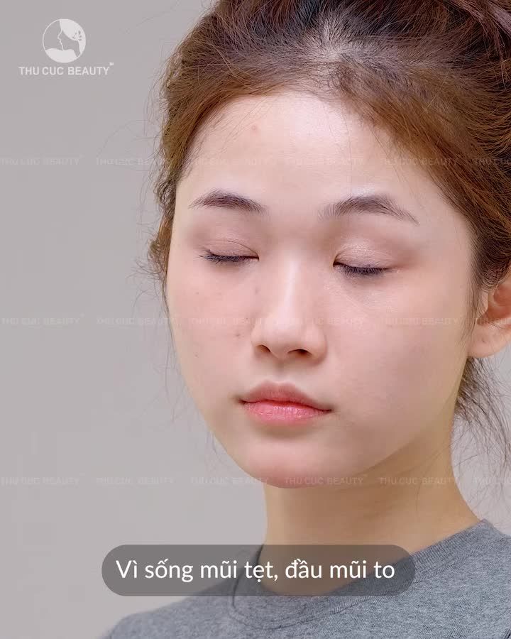 “Giải cứu” mũi tẹt, đầu mũi to cùng Mũi TC 13.5Tr