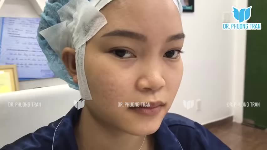 Đây là hình ảnh của một bạn chuẩn bị bước vào ca mũi cấu trúc.