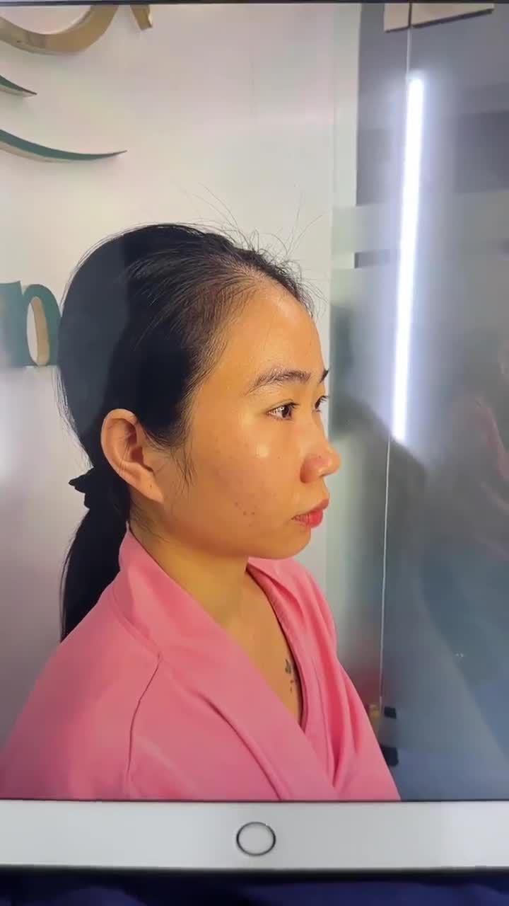 KẾT QUẢ SAU 10 NGÀY NÂNG MŨI CẤU TRÚC DR.HOẠT