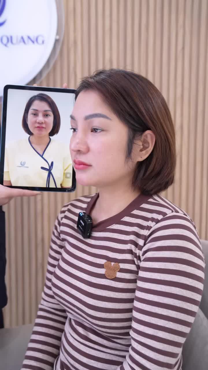 10 ngày "hồi sinh" dáng mũi “mọc từ trán” cho chị khách hàng Phú Thọ