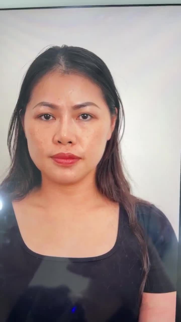 KẾT QUẢ SỬA LẠI MŨI HỎNG CHO KHÁCH HÀNG TRACY NGUYỄN (VIỆT KIỀU MỸ)