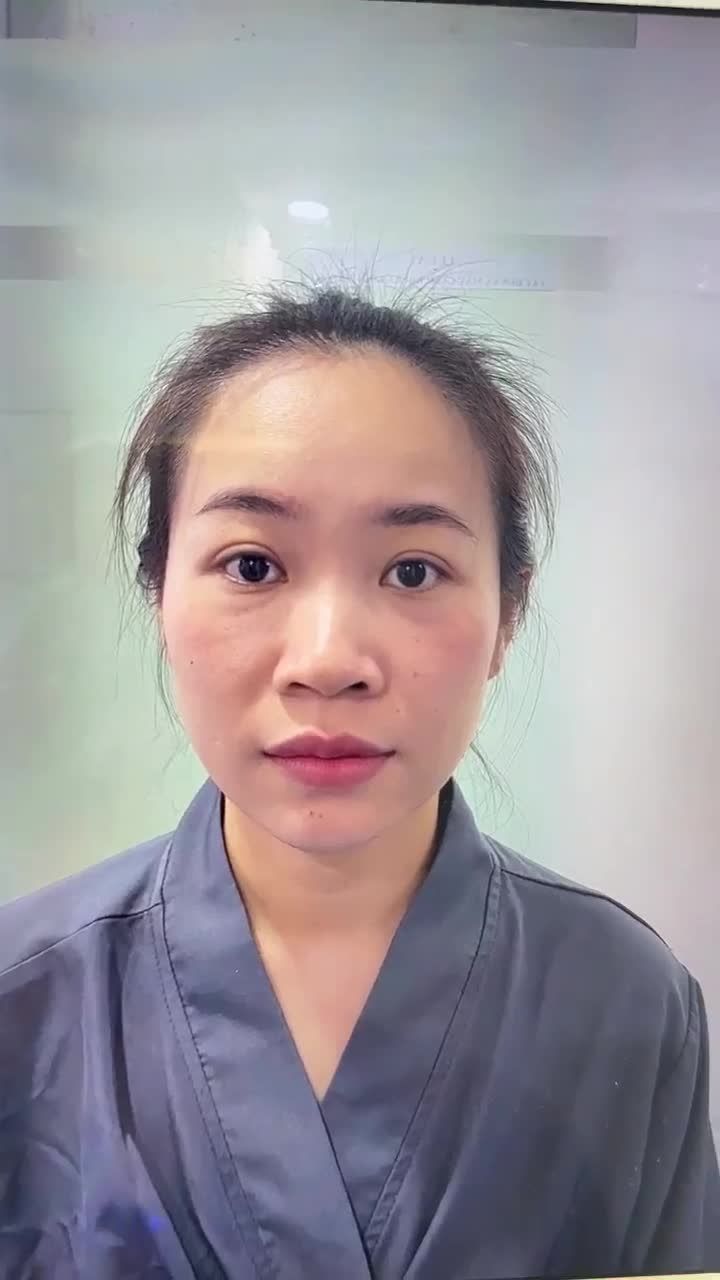 SAU 60 PHÚT NÂNG MŨI CẤU TRÚC + CẮT CÁNH MŨI