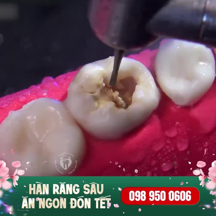 HÀN TRÁM RĂNG SÂU - TỰ TIN ĂN NGON ĐÓN TẾT