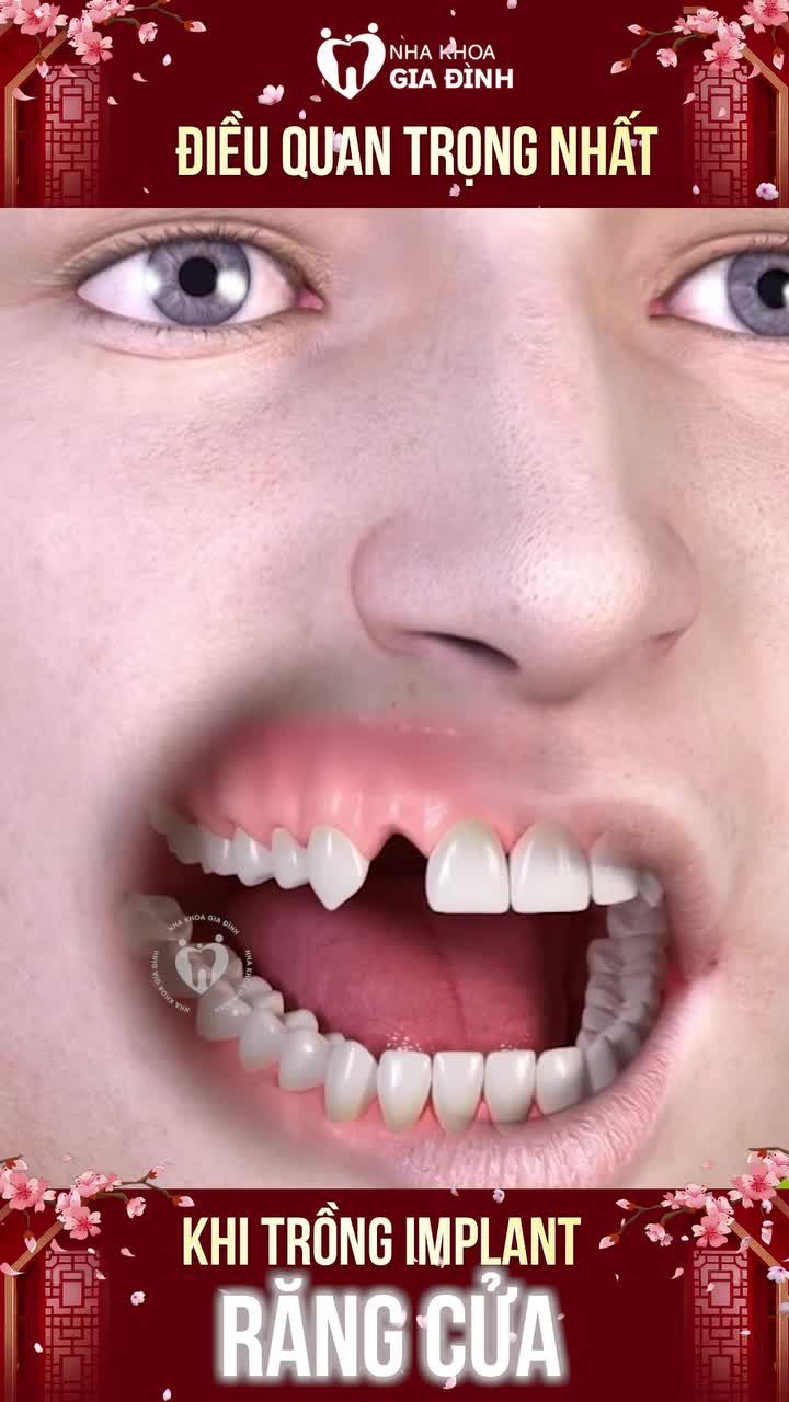 TRỒNG IMPLANT RĂNG CỬA – ĐỪNG BỎ QUA NHỮNG LƯU Ý QUAN TRỌNG