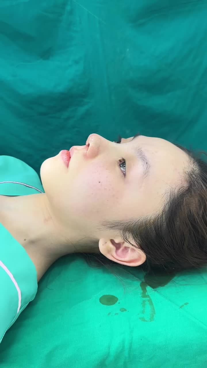 Mũi cấu trúc surgiform vừa hoàn thành