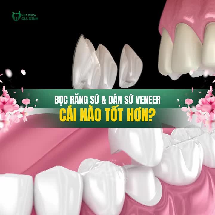 BỌC SỨ VÀ DÁN SỨ VENEER PHƯƠNG PHÁP NÀO TỐT HƠN?