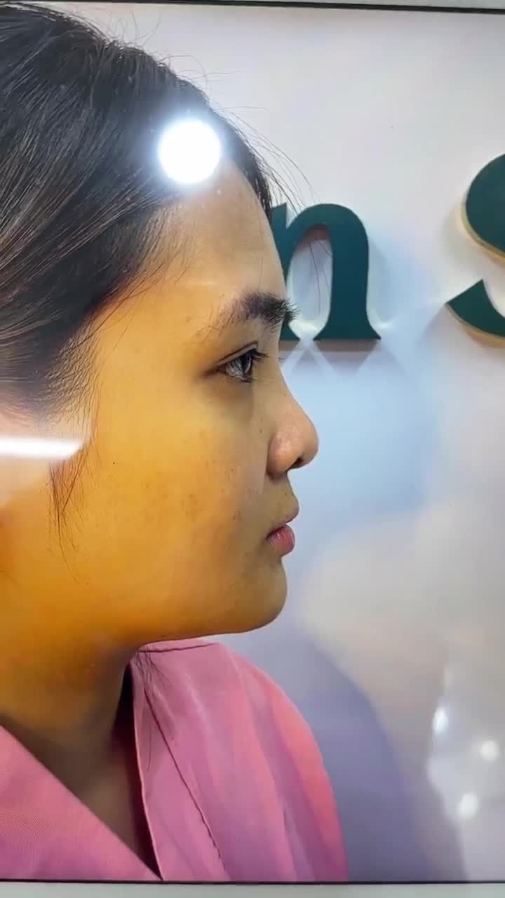 KẾT QUẢ SAU 60 PHÚT NÂNG MŨI CẤU TRÚC DR. HOẠT