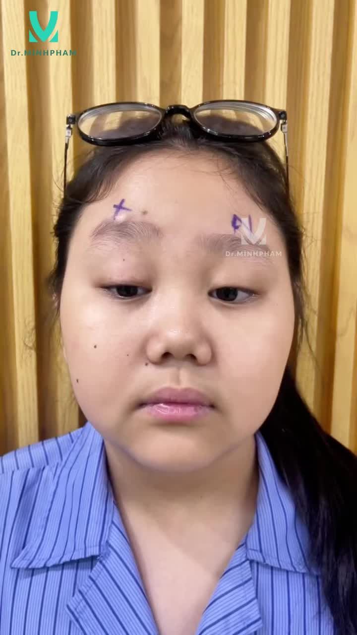 Phẫu thuật sụp mi bẩm sinh sau 5 tháng sẽ thế nào?