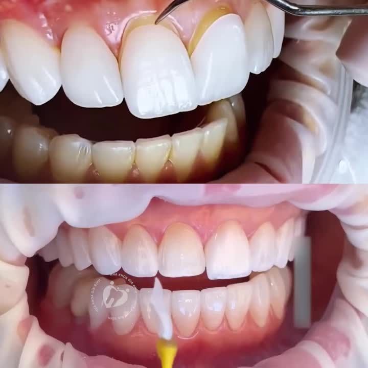 KHÔNG MÀI NHỎ RĂNG, BẢO TỒN RĂNG THẬT CHỈ CÓ THỂ LÀ DÁN SỨ VENEER