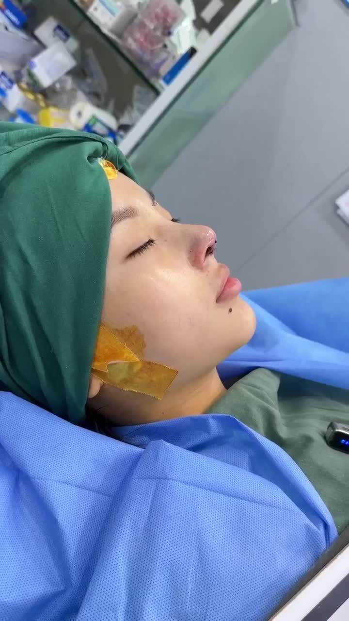 KẾT QUẢ NÂNG MŨI CẤU TRÚC - KHẮC PHỤC MŨI HỎNG CHO EM KHÁCH 2K1