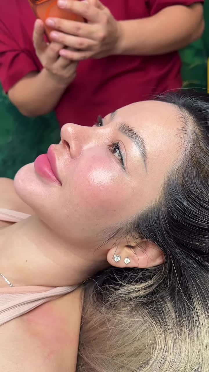 Mũi cấu trúc nâng cấp tái khám sau gần 1 tháng!!