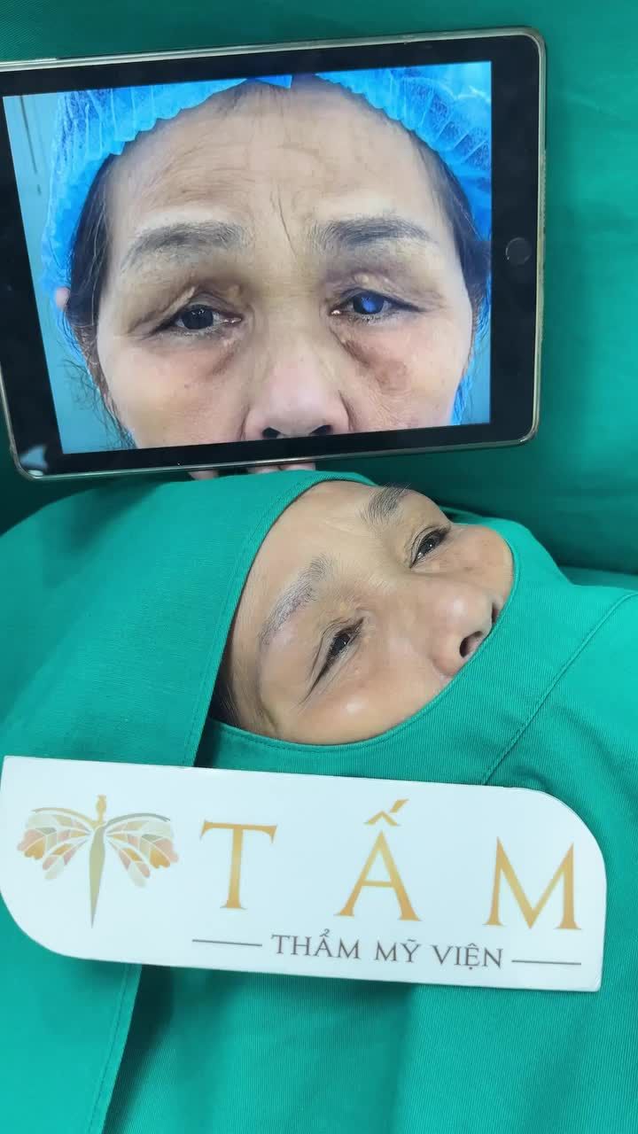 Trẻ hóa đôi mắt cho khách hàng 62 tuổi chỉ sau 1 dịch vụ duy nhất!