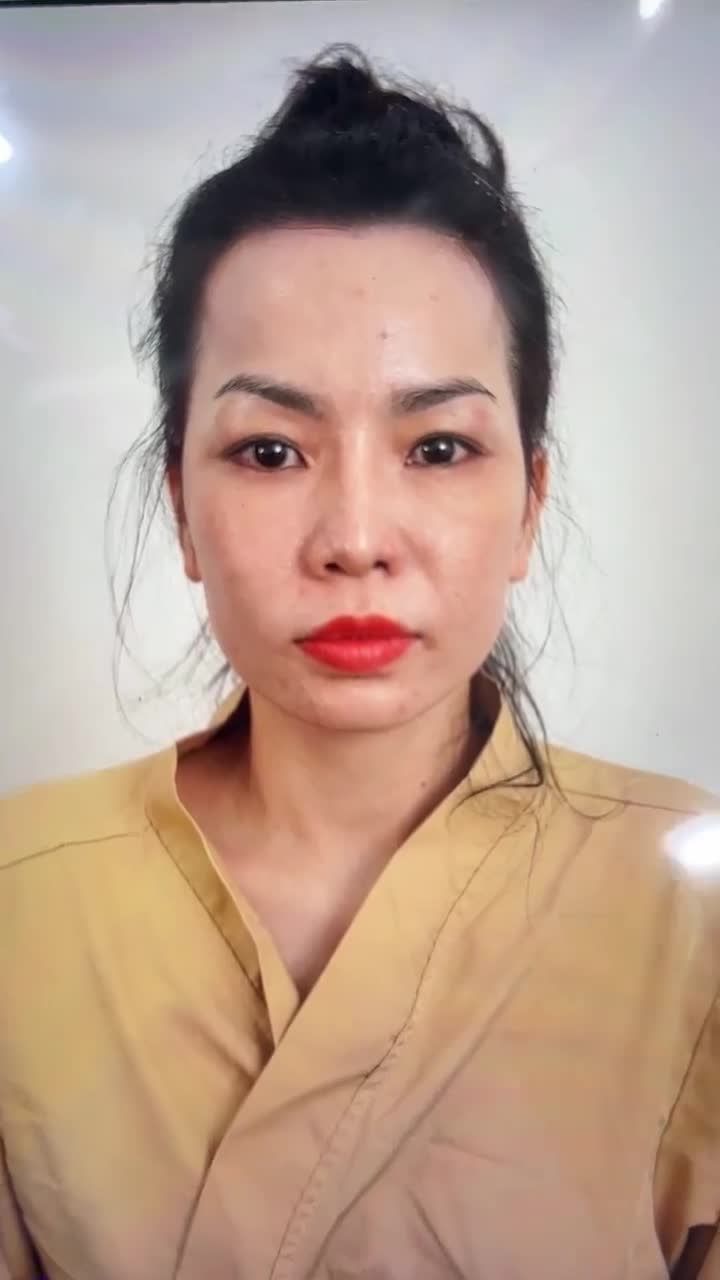 KẾT QUẢ NÂNG MŨI CẤU TRÚC DR. HOẠT - SỬA LẠI MŨI HỎNG KH. ANH THƯ (ĐÀI LOAN)
