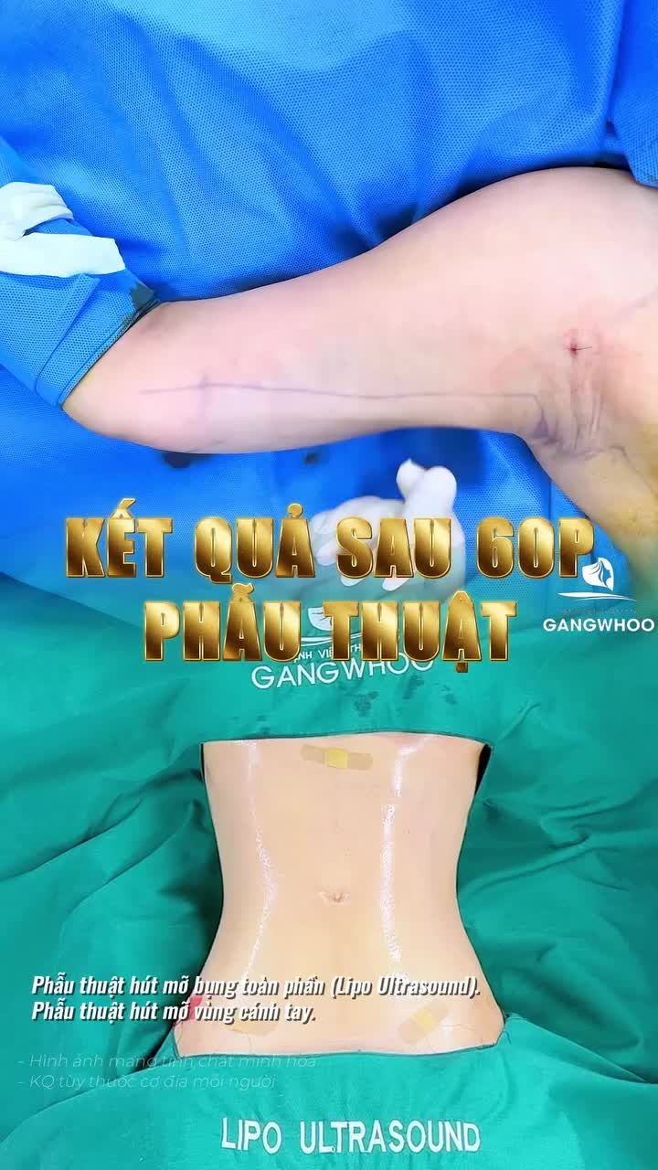Việt kiều Úc chốt đơn combo giảm mỡ bụng, bắp tay và kết quả sau phẫu thuật không đau, nhẹ nhàng