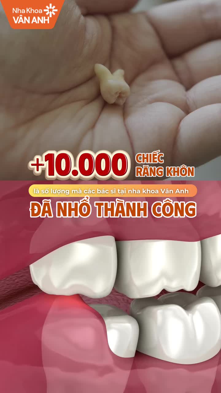 TẾT NÀY BÁNH CHƯNG MỠ HÀNH - ĐỪNG ĐỂ RĂNG KHÔN "HOÀNH HÀNH" MẤT VUI!