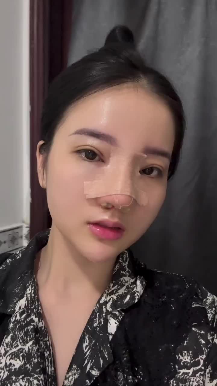 Lấy hết can đảm để nâng mũi, để thay đổi bản thân...và cái kết quá xứng đáng sau 1 tháng!!