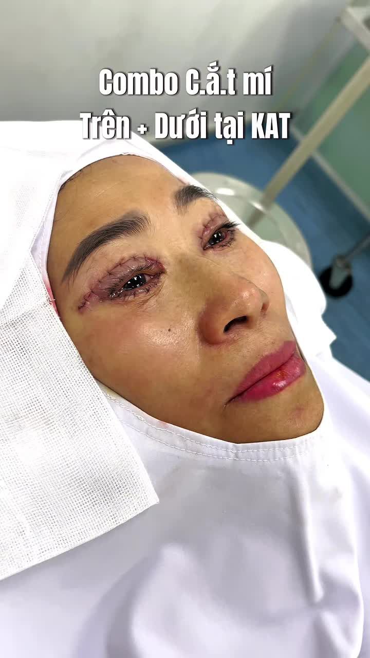 Một lần làm – Trẻ toàn diện đôi mắt