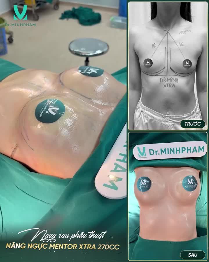 MENTOR XTRA – LỰA CHỌN ĐƯỢC NHIỀU CHỊ EM TIN TƯỞNG