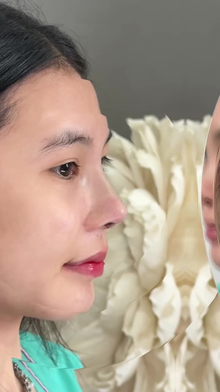 NÂNG MŨI CẤU TRÚC – DÁNG MŨI ĐẸP CHUẨN, HÀI HÒA THANH TÚ