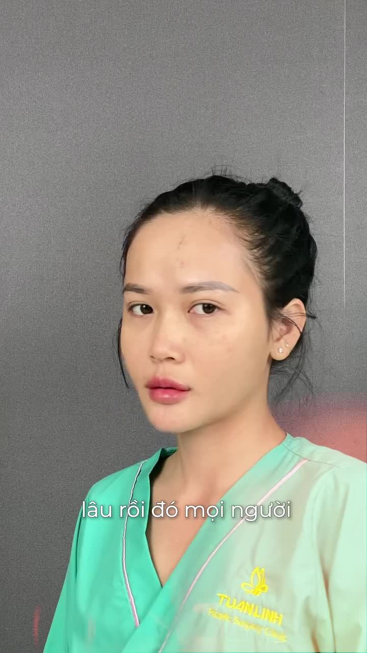 TỪ TIÊM FILLER KHÔNG NHƯ Ý → NÂNG MŨI CẤU TRÚC TẠI TUẤN LINH ĐẸP CHUẨN TỪNG MILIMET