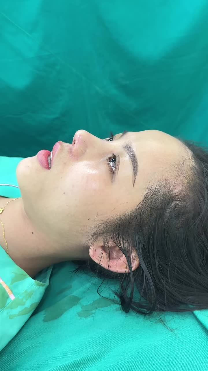 Case mũi cấu trúc sửa lại sóng Surgiform cho bạn khách từ nước ngoài về Việt Nam và chọn Tuấn Linh để làm mũi!!