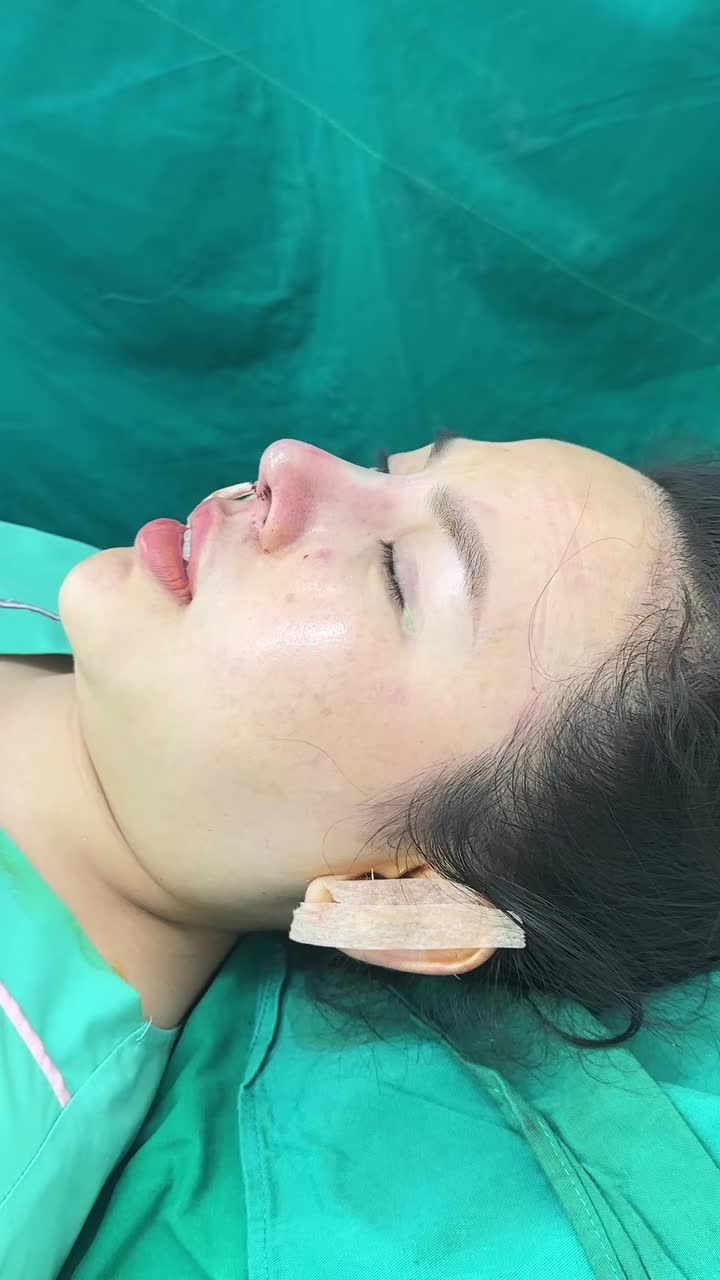 Case mũi tái cấu trúc sửa lại cho khách hàng đến từ Gia Lai!!