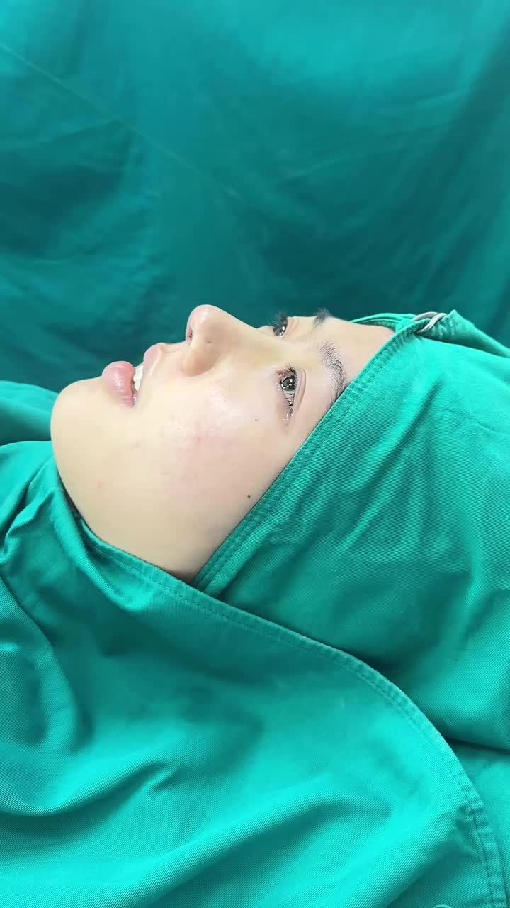 Case Nâng mũi cấu trúc - Dáng mũi tự nhiên, đầu mũi tròn bay!!