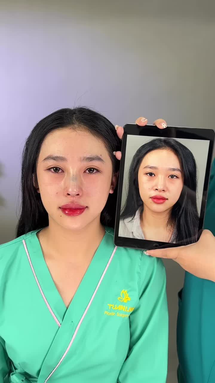 Case Nâng mũi cấu trúc - Dáng mũi cao bay tự nhiên sắc nét!!