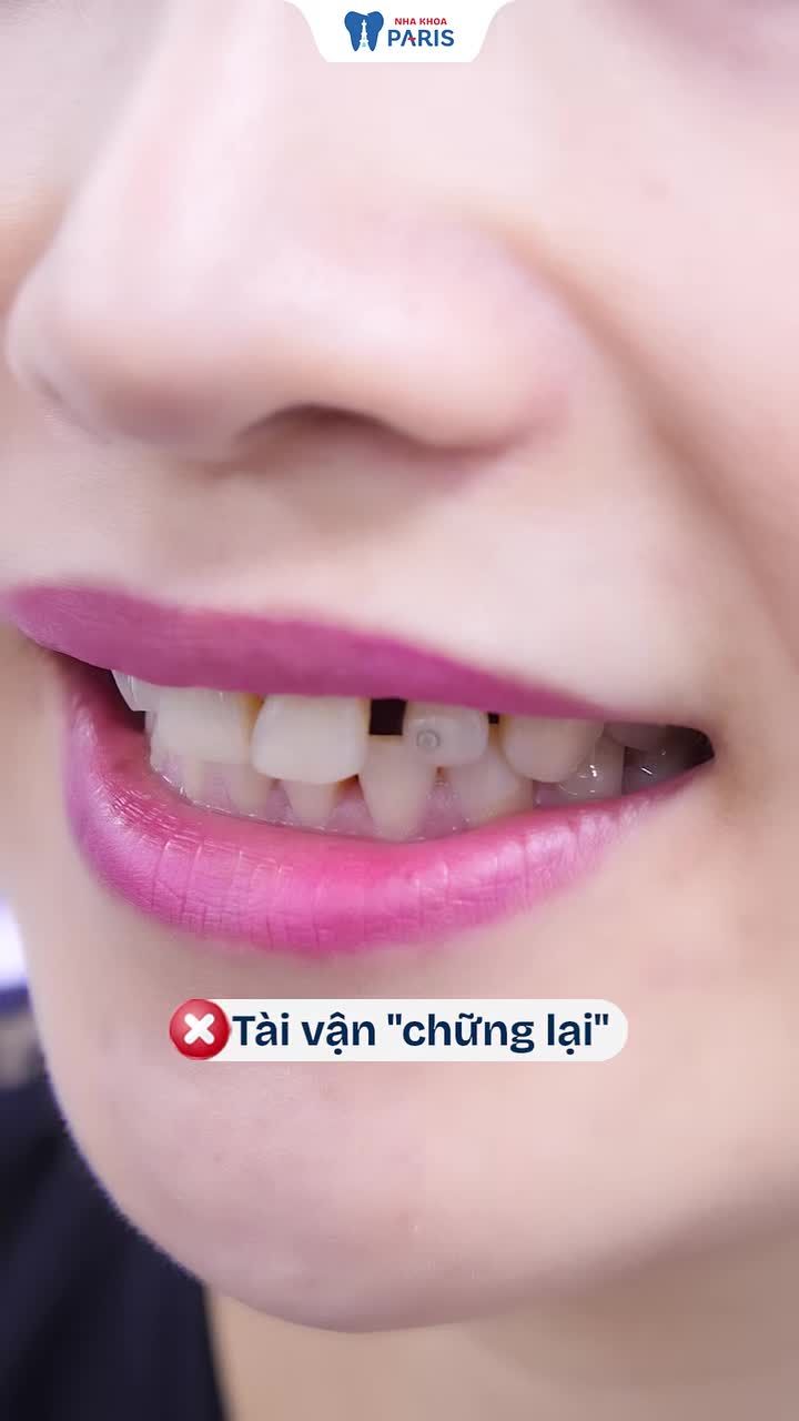 Răng ố màu, sứt mẻ – cười chưa trọn, lộc cũng khó tròn