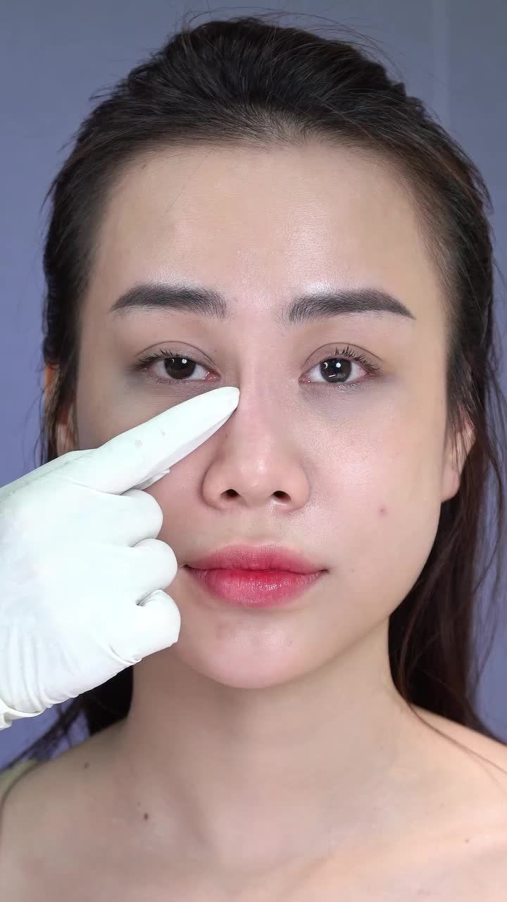 Làm mũi chỉ không lên được dáng ưng ý, đợi tan để làm lại nhưng đợi 3 năm cũng chưa tan mà còn bị co rút, lõm sóng mũi.