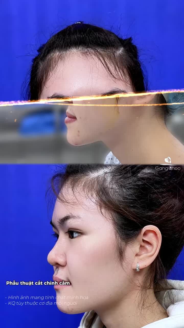 Trượt hàm trên dưới – chỉnh lại cấu trúc, trả về sự cân đối