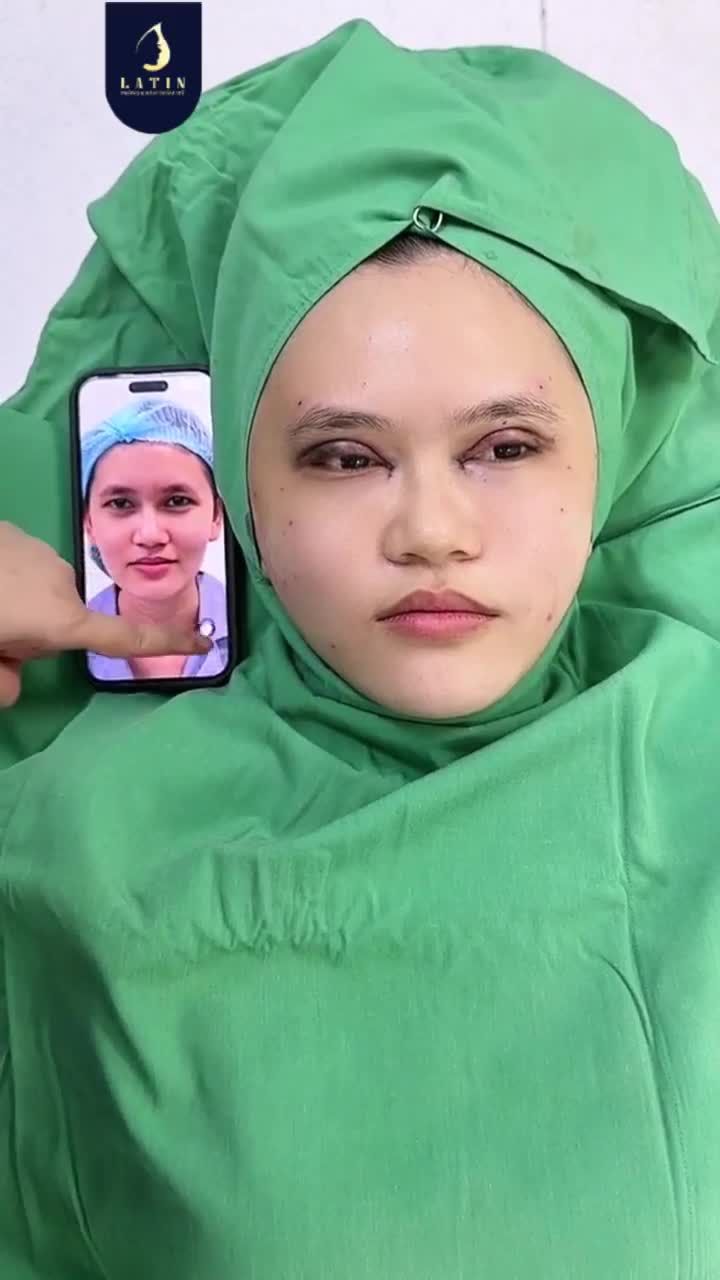 CHIA SẺ CA LÀM ĐẸP THỰC TẾ KHÁCH NỮ 32 TUỔI CẮT MÍ TRÊN 4D – MỞ GÓC MẮT TRONG – CẤY MỠ TOÀN MẶT