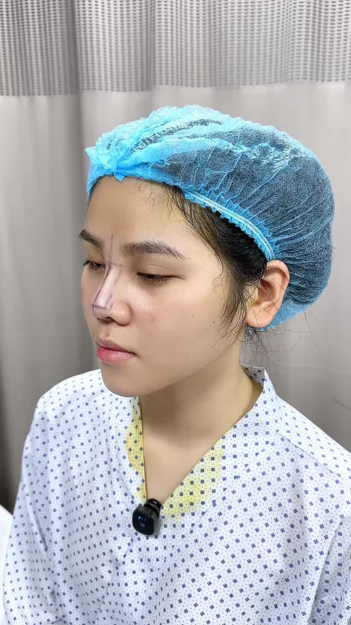 CẬN CẢNH DÁNG MŨI BỌC SỤN SAU 60 PHÚT – ĐẸP TỰ NHIÊN, KHÔNG LO SƯNG BẦM