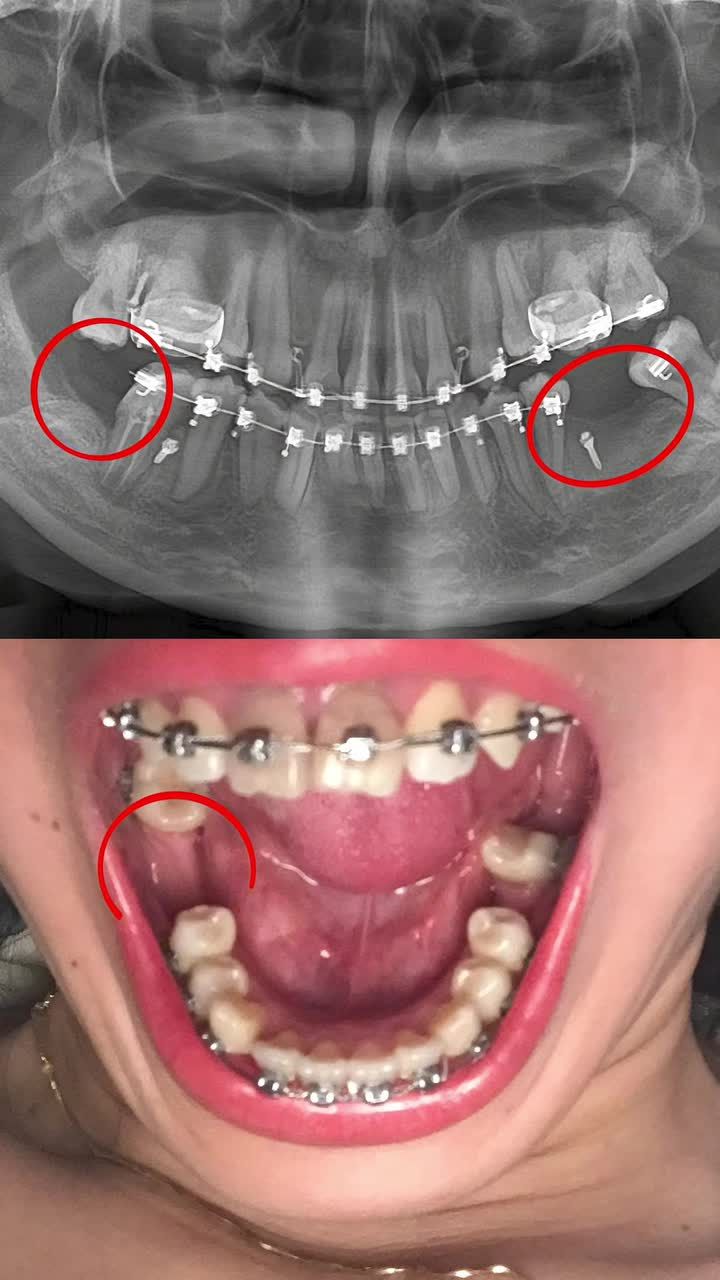 Trồng răng đón Tết - 15 phút răng bền trọn đời