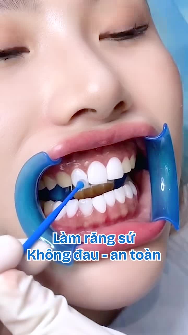 Chỉ 2 buổi – Tân trang nụ cười đón Tết Làm răng sứ đẹp tự nhiên, nâng tầm diện mạo – đón Tết rạng rỡ