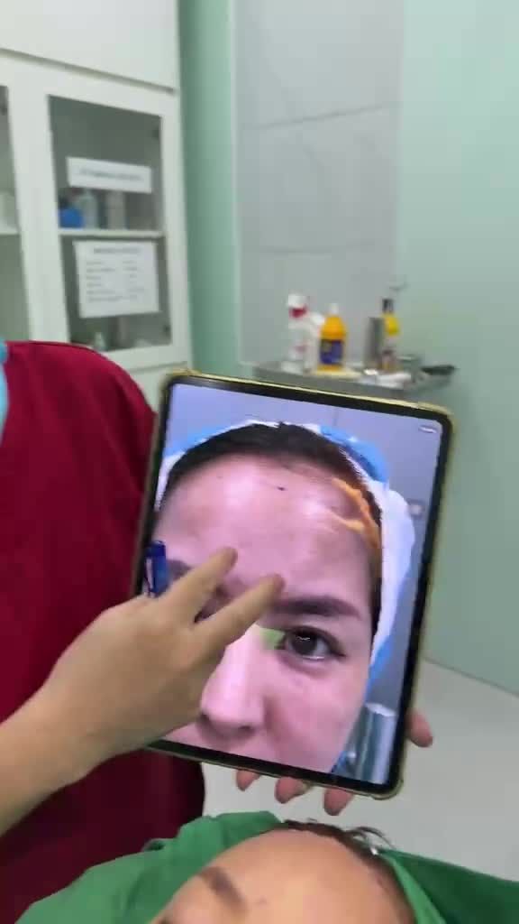 Hạ đường chân tóc với Dr Vương (cho bạn gái Việt kiều về từ Singapore) : Xử trí triệt để trán rô, trán hô, trán hói, …