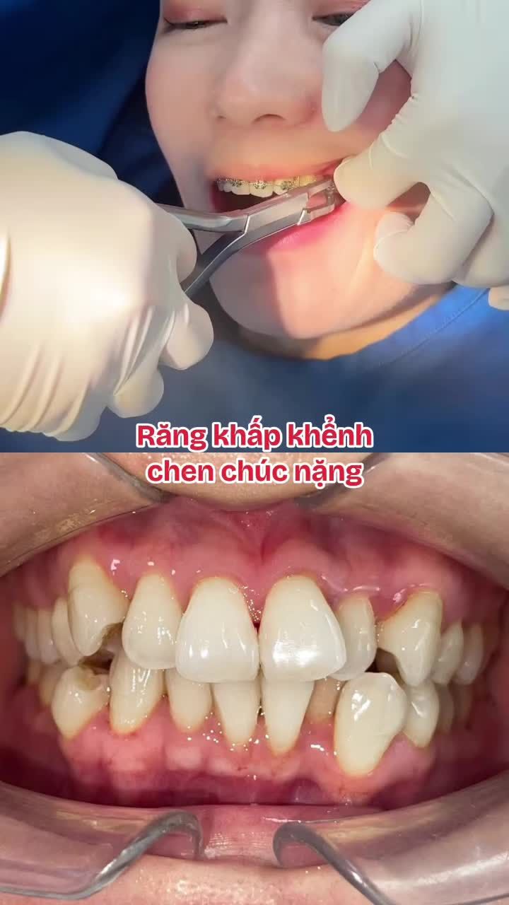 9x tháo niềng: Cười xinh hơn - Trẻ ra hẳn 5 tuổi