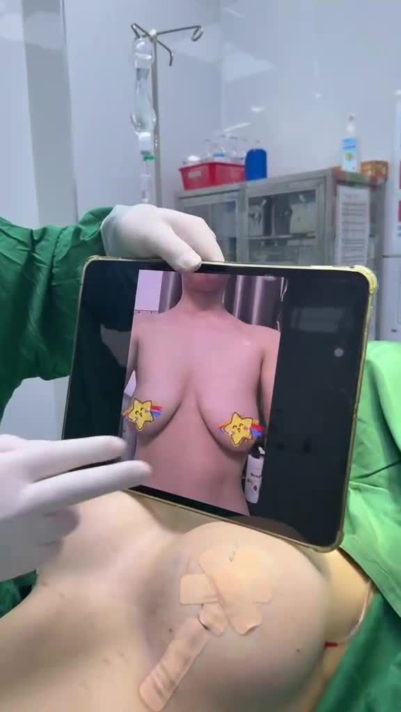 Nâng ngực Ergonomix 285cc và treo sa trễ sẹo thẳng với Dr