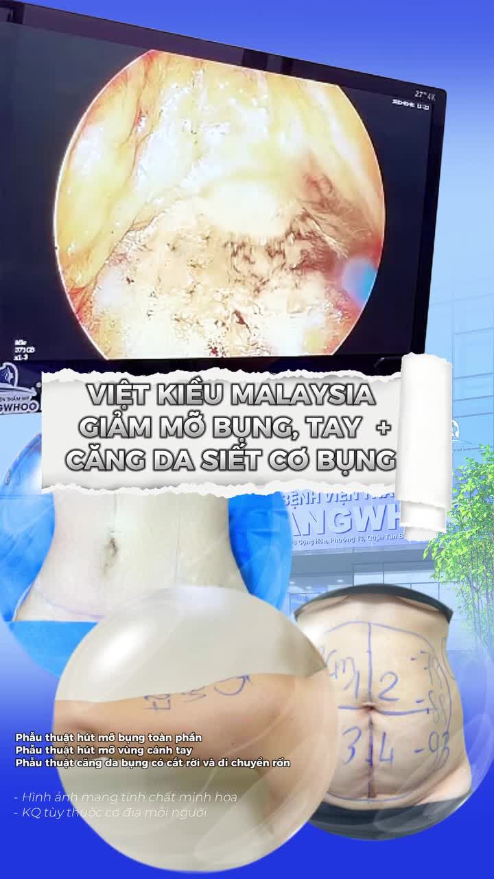 Việt kiều Malaysia lựa chọn giải pháp kết hợp giảm mỡ bụng, giảm mỡ cánh tay và căng da siết cơ bụng, giúp xử lý đồng thời mỡ dư thừa và tình trạng da chảy xệ.