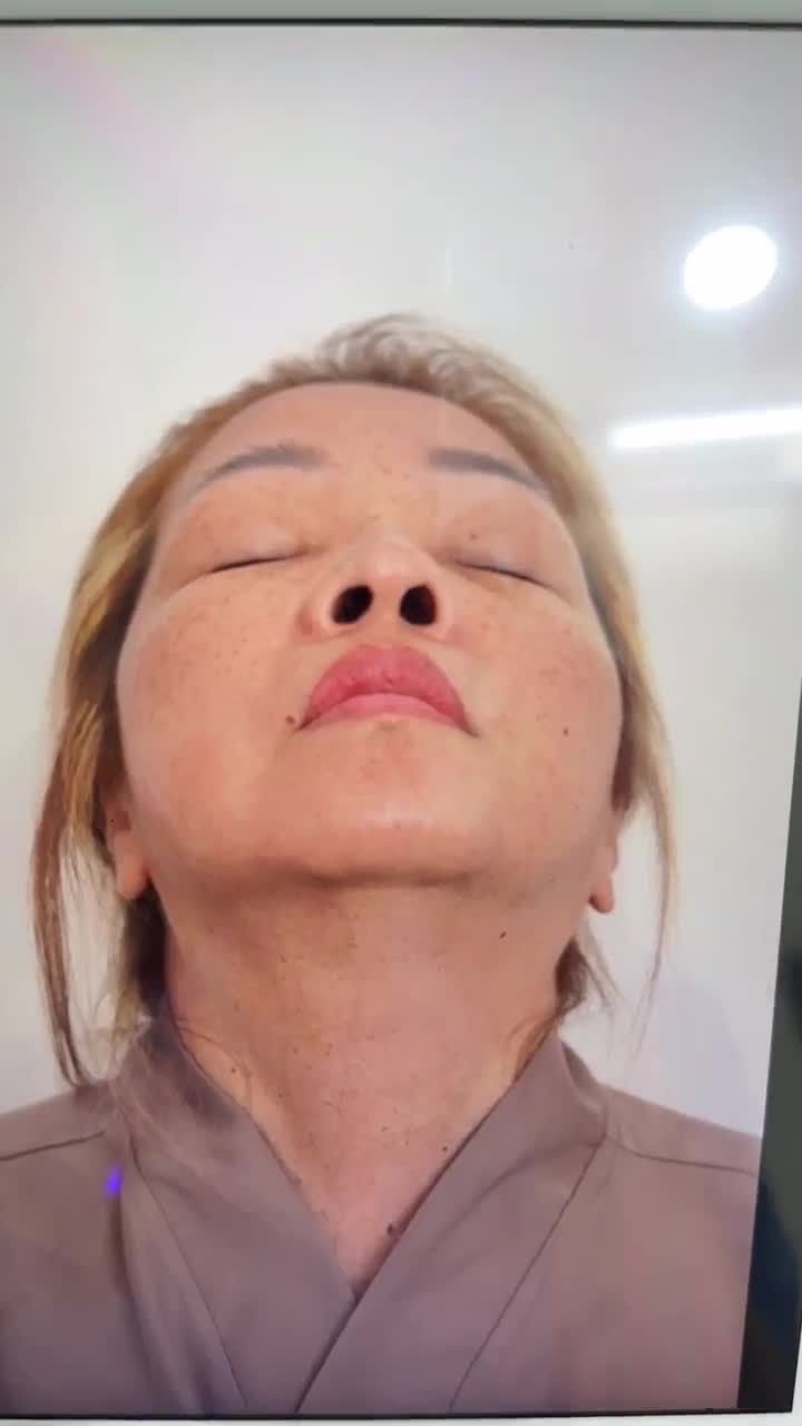 KẾT QUẢ NÂNG MŨI SỬA LẠI KH. KIM HẠNH (VIỆT KIỀU MỸ)