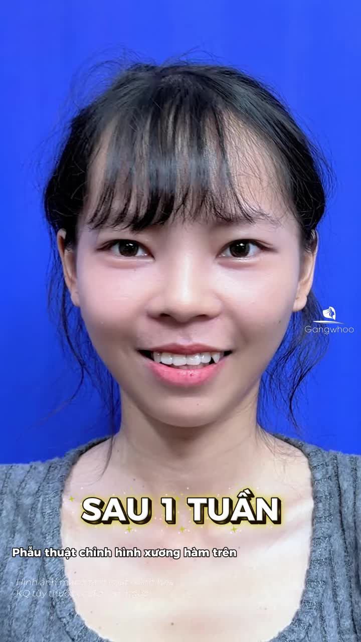 Khi gương mặt tìm lại đúng trục chuẩn