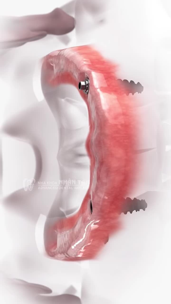 KHI NÀO NÊN TRỔNG RĂNG IMPLANT TOÀN HÀM?