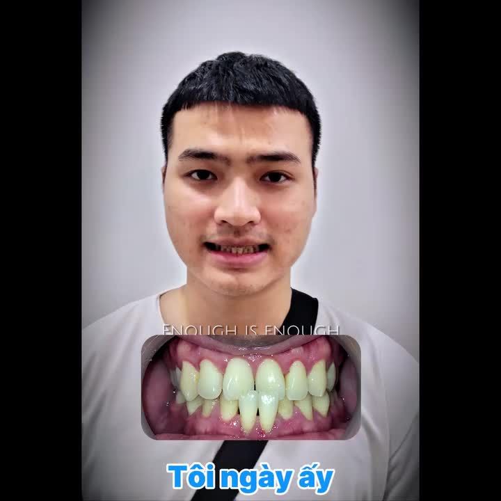 CHÚC MỪNG BẠN ĐỨC TUẤN (2000) THÁO NIỀNG THÀNH CÔNG KHI NỤ CƯỜI KHÔNG CÒN LÀ RÀO CẢN